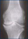 Joint Degeneration